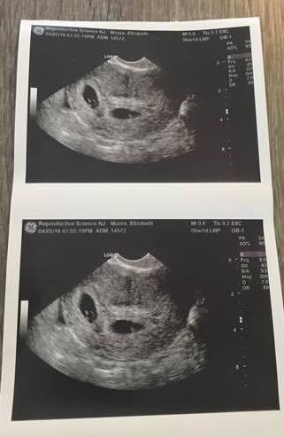 Early twin ultrasound at 6 weeks with twins