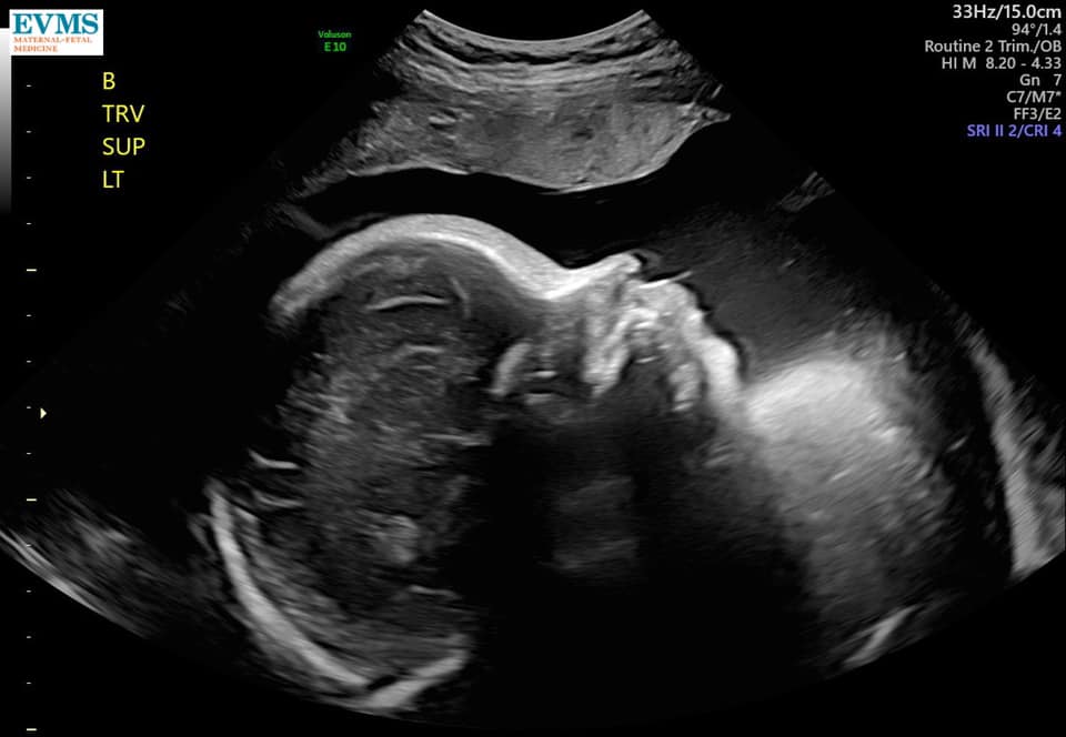 32 Wochen schwanger mit Zwillingen