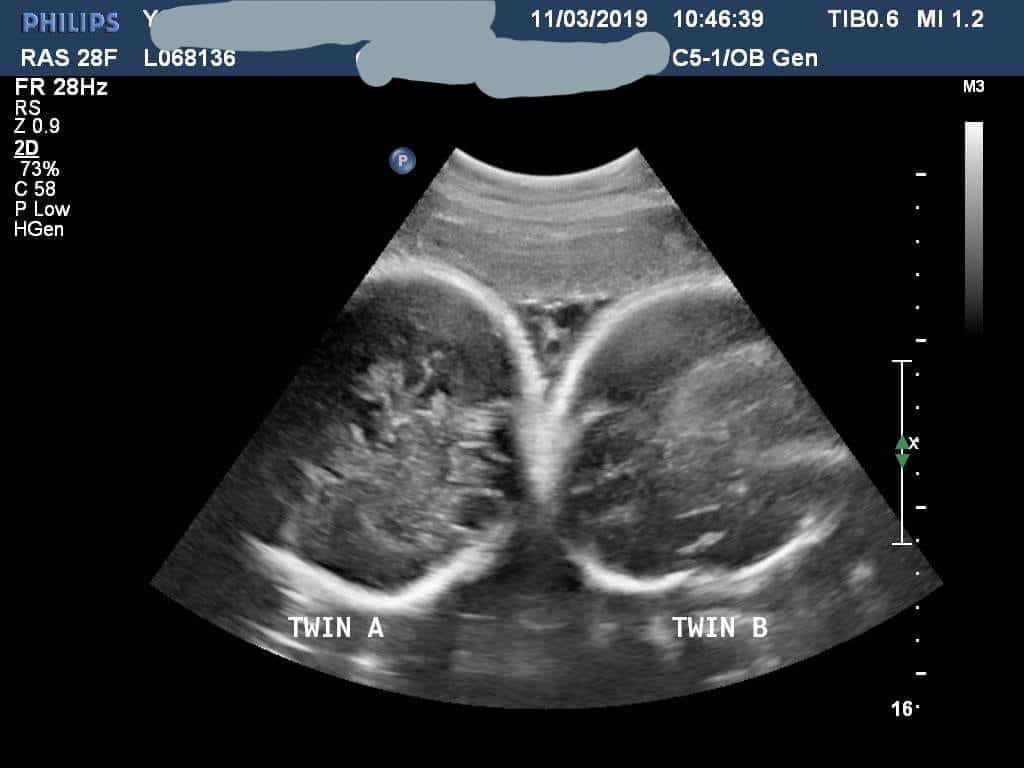 双子妊娠35週