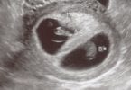 twins first trimester
