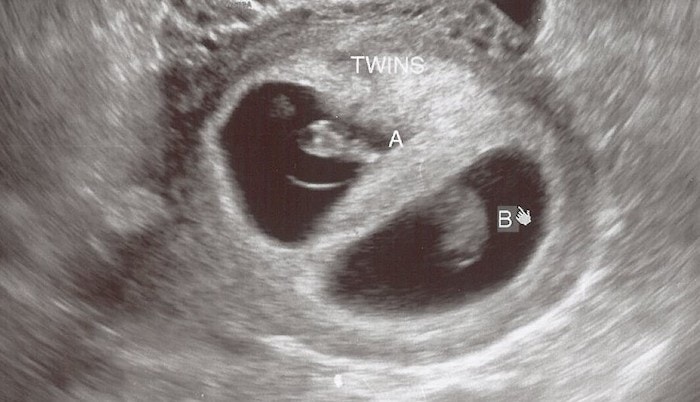 twins first trimester
