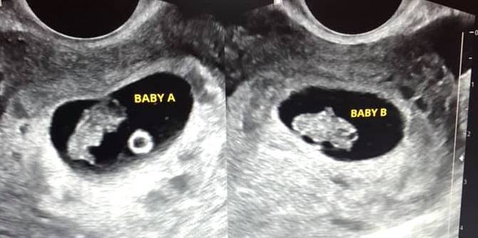 twin pregnancy 7 week ultrasound