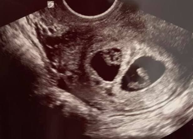 Ultrasound 7 twins week Hidden Twin: