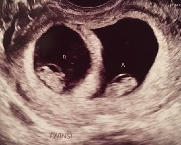 7 Weeks Pregnant With Twins