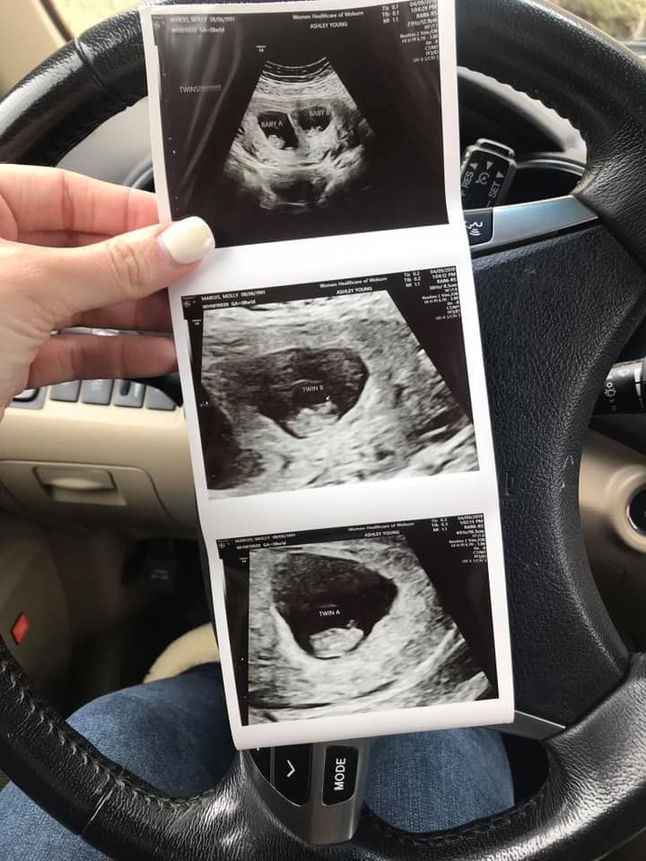 7 Weeks Pregnant With Twins