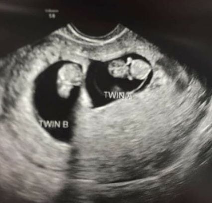 7 Weeks Pregnant With Twins