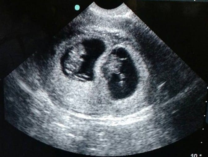 Our first ultrasound at 8 weeks pregnant for our first pregnancy. 