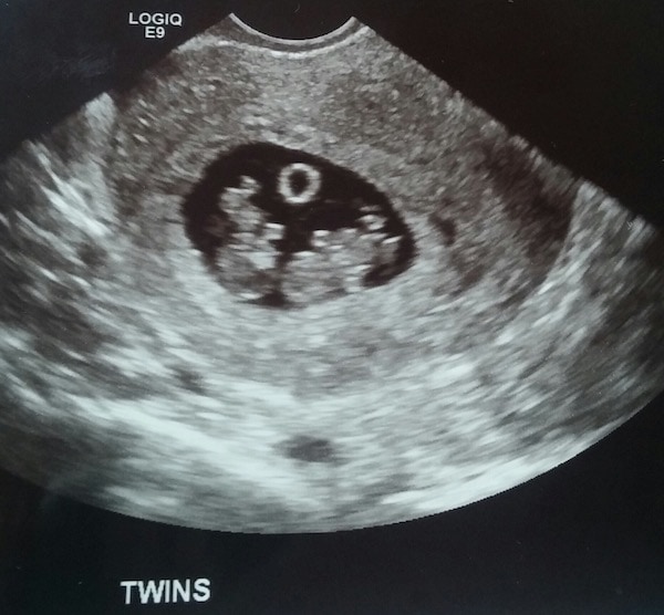 twins first trimester