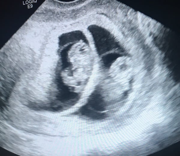 14 Weeks Pregnant Ultrasound Twins