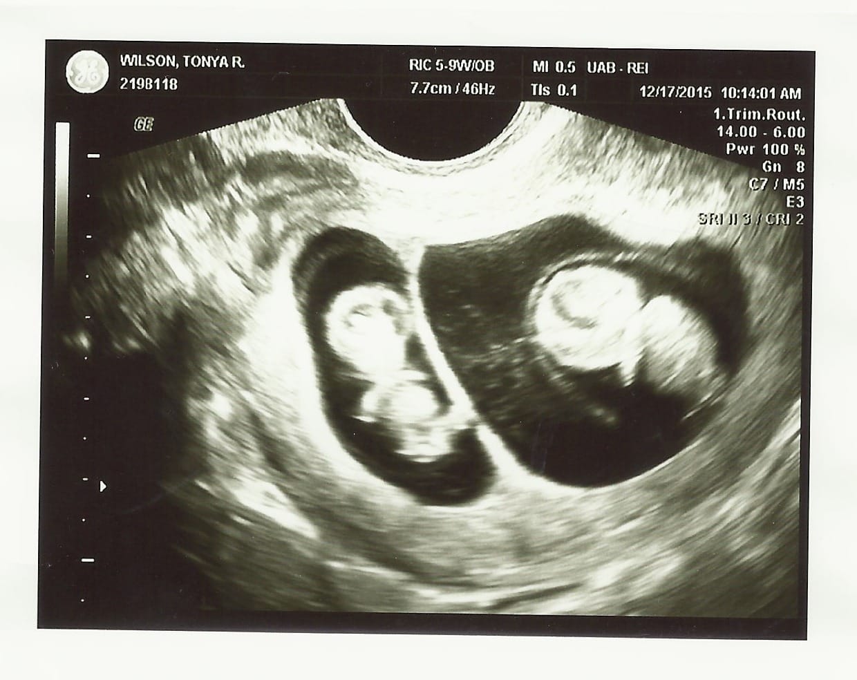 9 Weeks Pregnant Twins