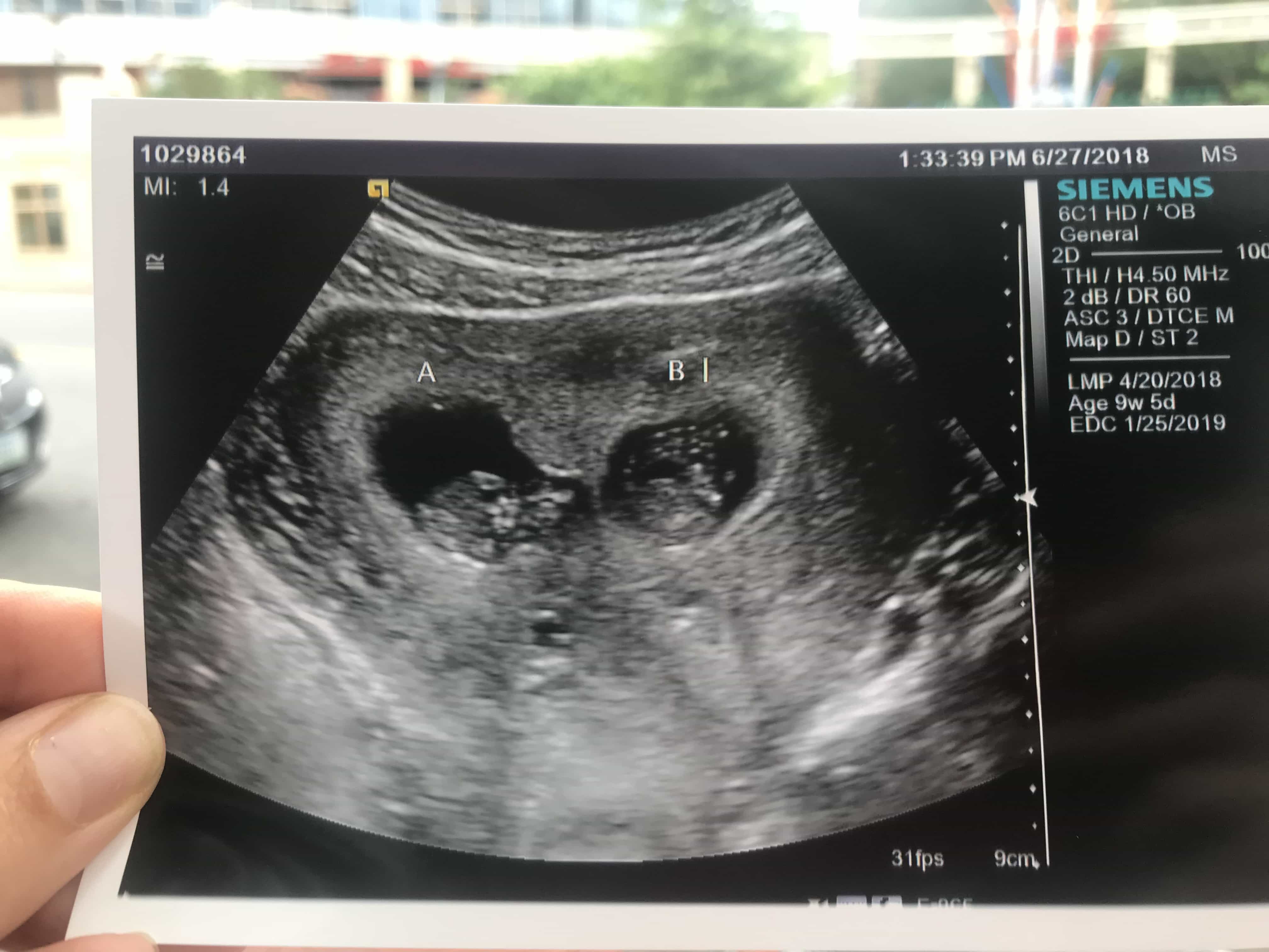 9 Week Ultrasound Twins