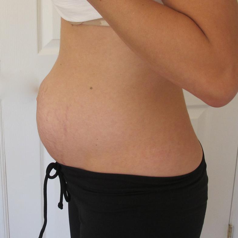 diastasis recti