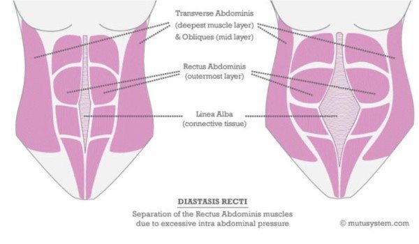 diastasis recti