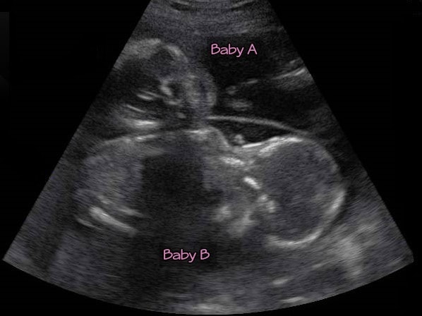 ultrasound twins at a birthing center