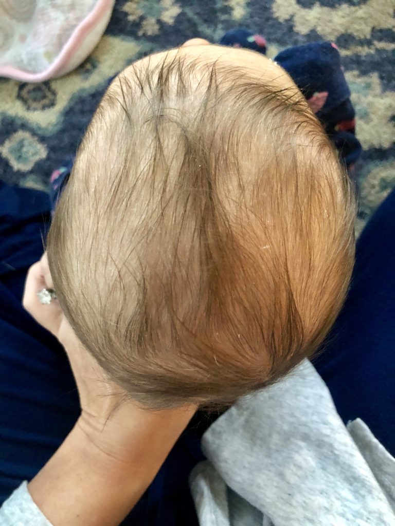 baby's head plagiocephaly