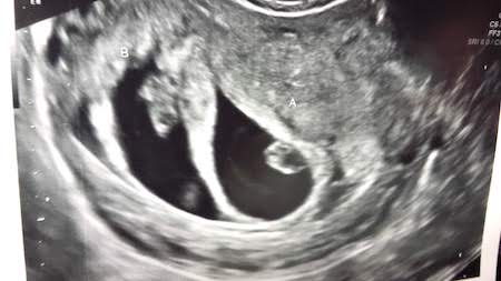 sonogram twins irritable uterus