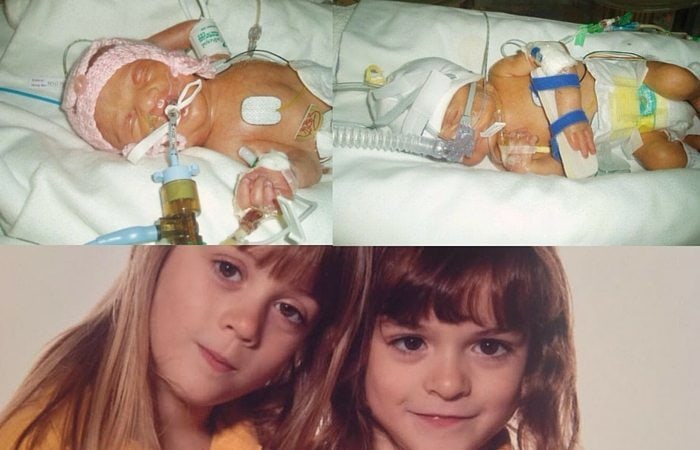 Camilla and Saskia now aged 6.5 years - 8 week stay in NICU. Born at 29 weeks