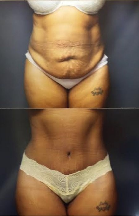 Before and after Abdominoplasty and Diastasis repair