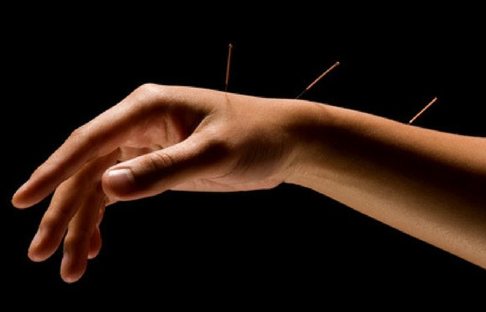 acupuncture on carpal tunnel