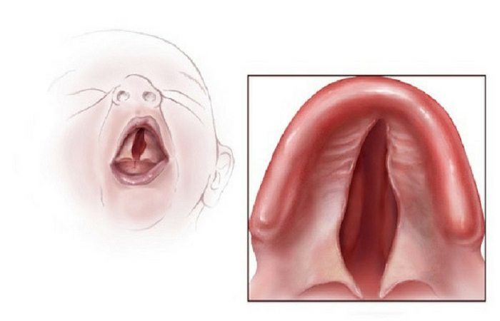 cleft palate