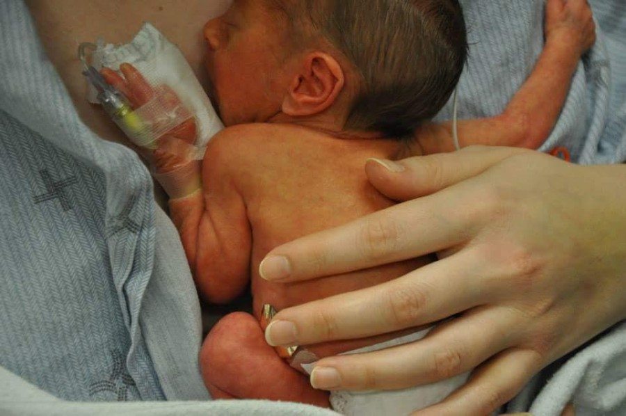 traumatic twins birth