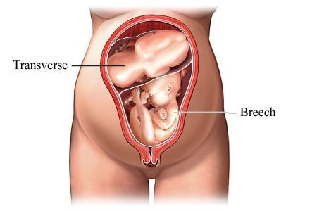 breech1