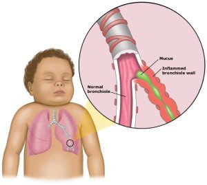 bronchiolitis1