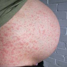 pregnancy belly with rash
cholestasis