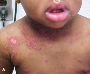 eczema