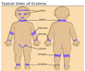 eczema sites