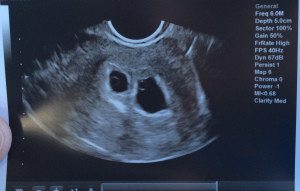 keithsonogram