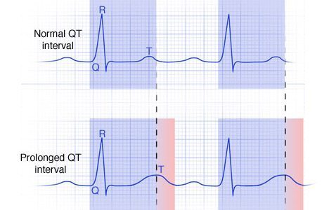 Long QT Syndrome