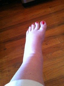 My swollen foot