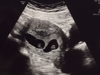 twins ultrasound time in the nicu