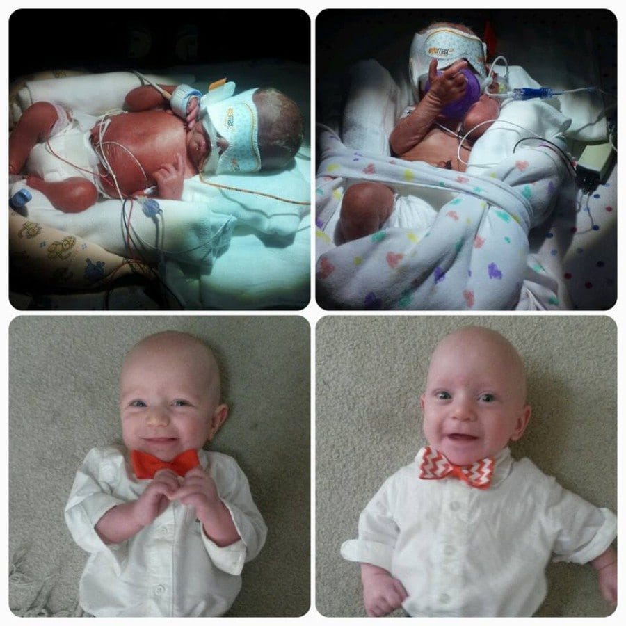 Born at 28.3 weighing 3.1 oz and 2.14 oz. Were in the NICU for 55 and 60 days. Now healthy, growing, crawling 9 month olds. Thankful for my miracle babies! preemie twins