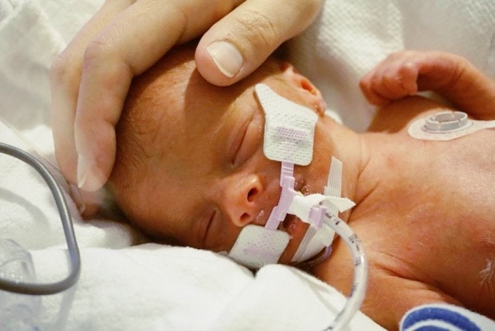 preemie baby ptsd after the nicu